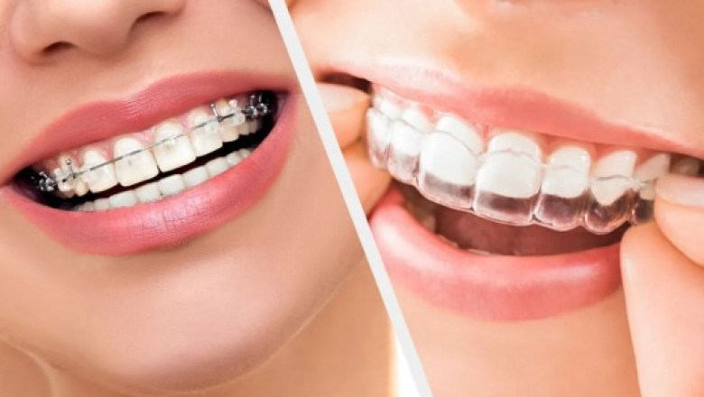 Invisalign vs Braces: Treatment, Duration and Results