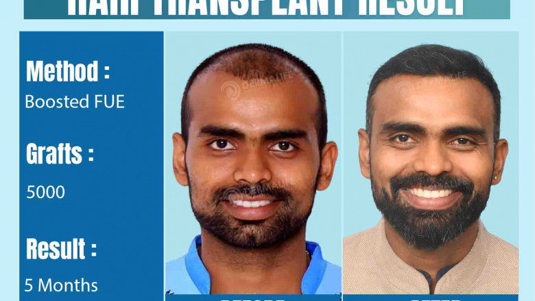 Who Does the Best Hair Transplants in the World?