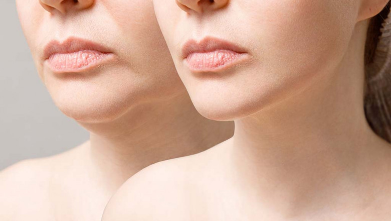 How Can Eyelid Surgery Improve the Appearance of My Eyes?
