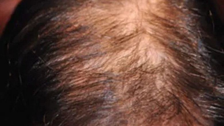 Can Hair Transplants Help In Reversing Hair Loss from Sertraline