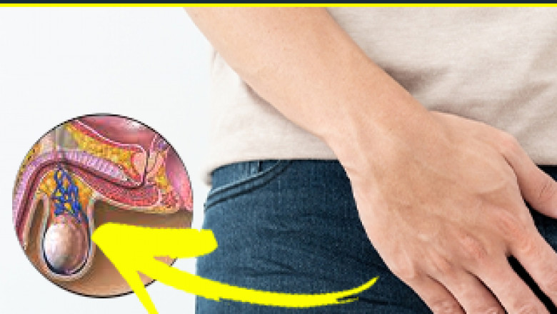 How to Reduce Varicocele and Varicose Veins with Homeopathy