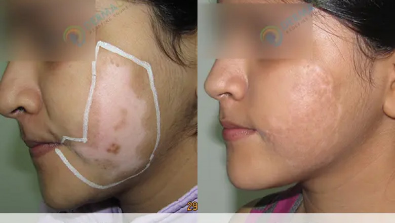 Vitiligo Treatment in Delhi, India: Causes, Spread, and Effective Treatments