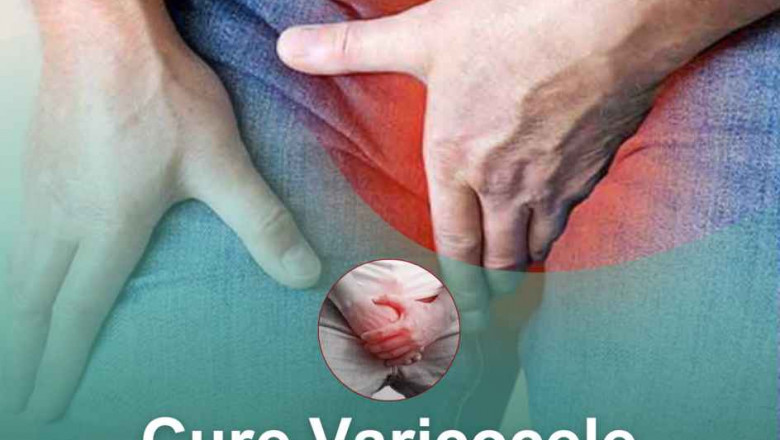 Natural and Homeopathic Remedies for Varicocele: Understanding and Managing the Condition Without Surgery