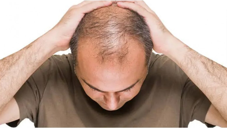 Does Saxenda Cause Hair Loss? Symptoms and Solutions