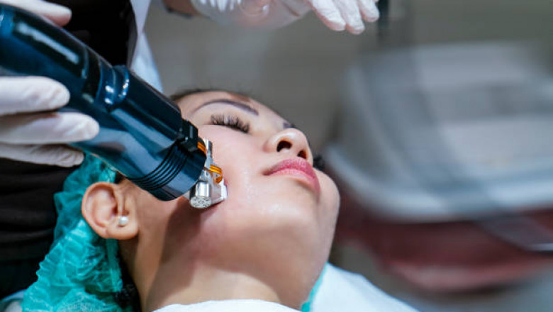 Microneedling Cost: What You Need to Know Before Your First Session