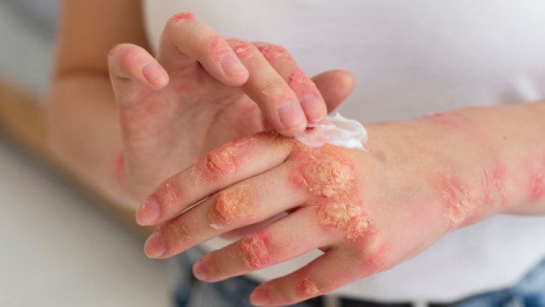 Eczema Cream vs. Moisturiser: What’s the Difference?