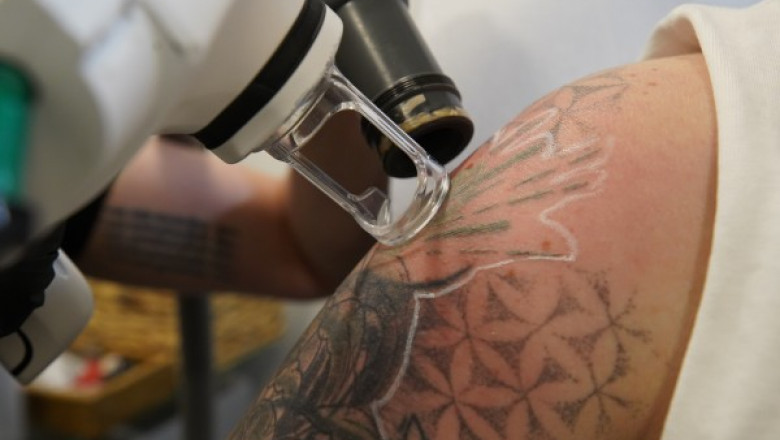Immediate Side Effects of Rejuvi Tattoo Removal