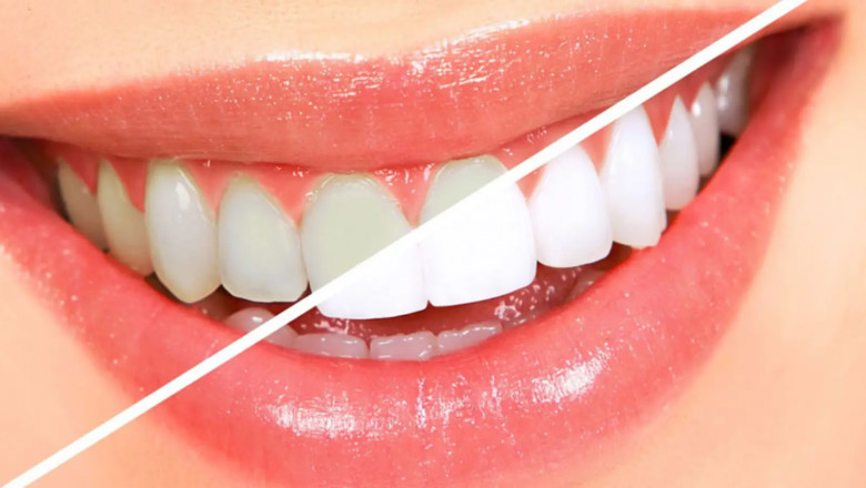The Ultimate Guide to Achieving a Hollywood Smile: Teeth Whitening Breakthroughs Explained
