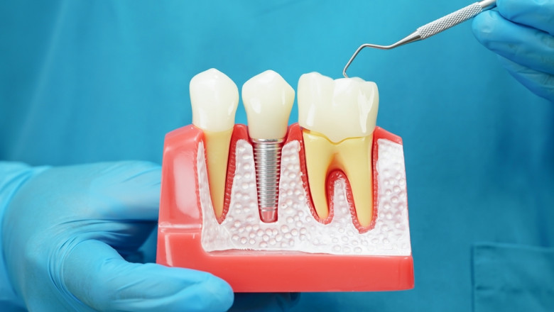 A Brighter, Healthier Smile: Exploring the Benefits of Dental Implants and Teeth Whitening