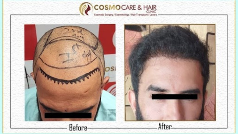 What You Should Know Before a Hair Transplant in Chandigarh