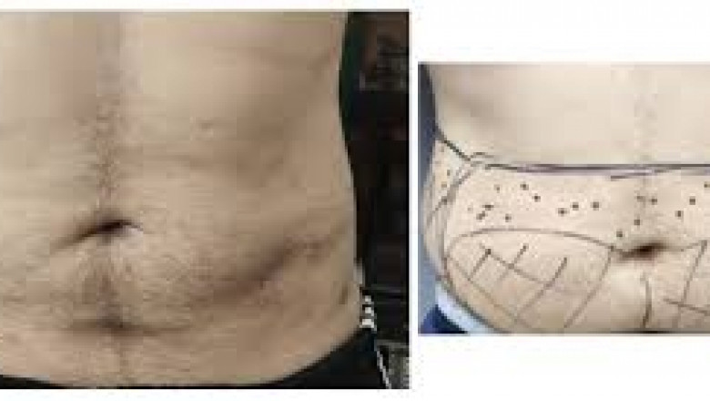 Liposuction Surgery: A Comprehensive Guide