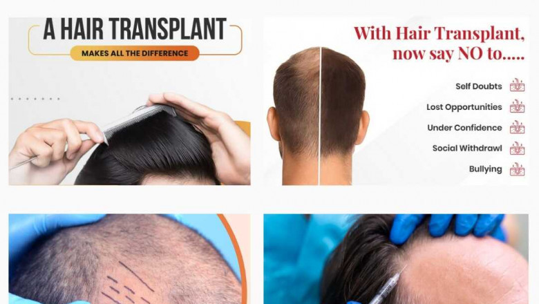 Factors That Affect Hair Transplant Cost in Chandigarh