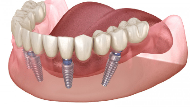Why You Need a Specialist for Reliable Dental Implants