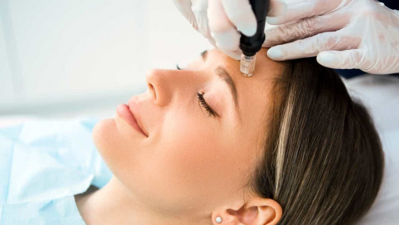How Does the DP4 Dermal Pen Reduce Acne Scars and Fine Lines?