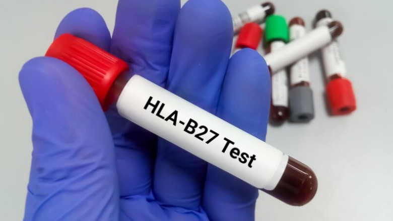 HLA B27 Test: Purpose, Procedure, Normal Range & Cost in India