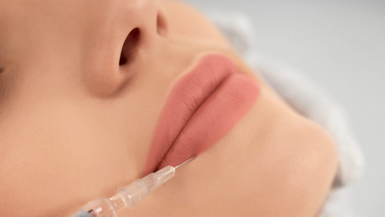 TikTok and the Rise of Russian Lip Fillers