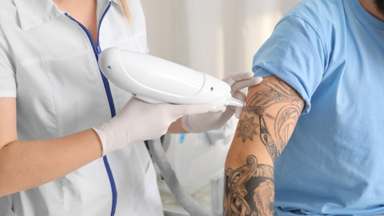 Does Tattoo Size Matter in Tattoo Removal Services?