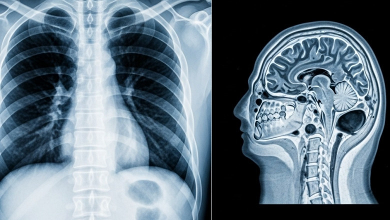 North America Diagnostic Imaging Market Analysis by Opportunities, Sales Revenue, Emerging Technologies, Segmentation, Future Plans Growth by 2028
