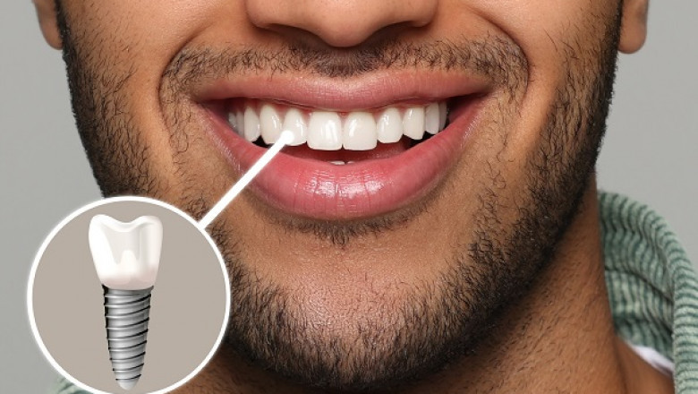 How a Dentist in Lethbridge Can Help You Restore Missing Teeth with Dental Implants