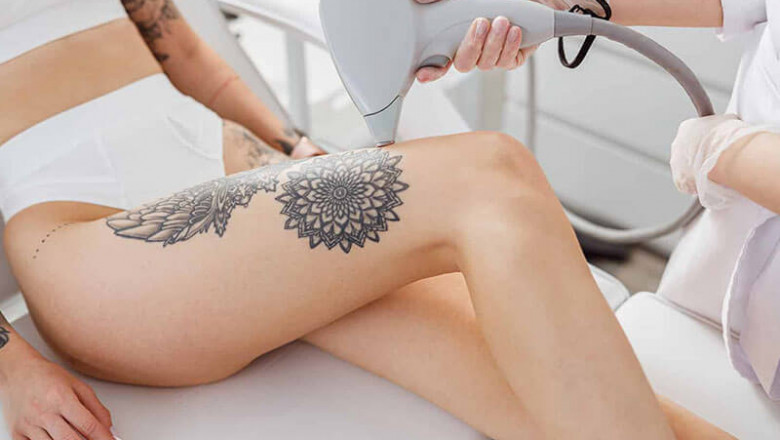 Can Laser Removal Fully Erase a Tattoo? The Reality