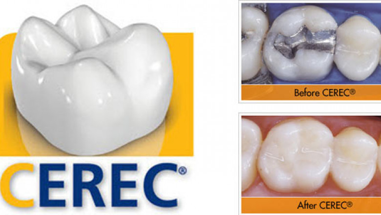 How CEREC Same-Day Crowns Work: High-Tech Dentistry in Markham