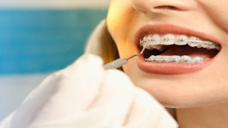 What Are Braces and How Do They Work?