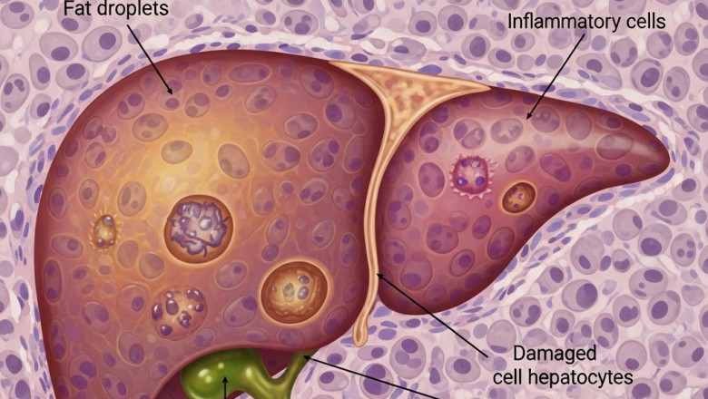 Europe Non-Alcoholic Steatopatitis Market Comprehensive Study, Industry research -2028