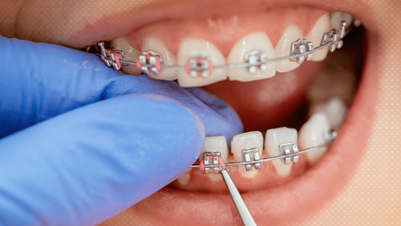 Expert Dental Braces in Dubai: Your Path to a Perfect Smile