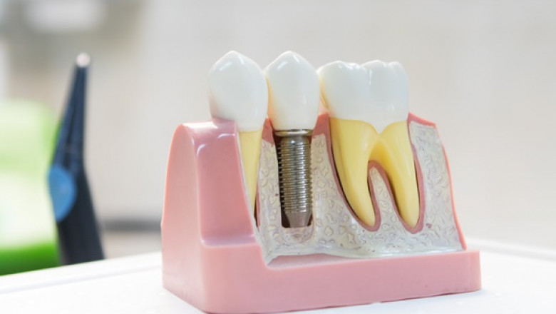 Brush Family Dentistry - Dental Implants and More