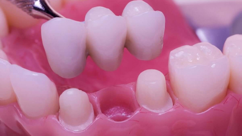 Dental Bridges Explained: How They Restore Your Smile and Oral Health