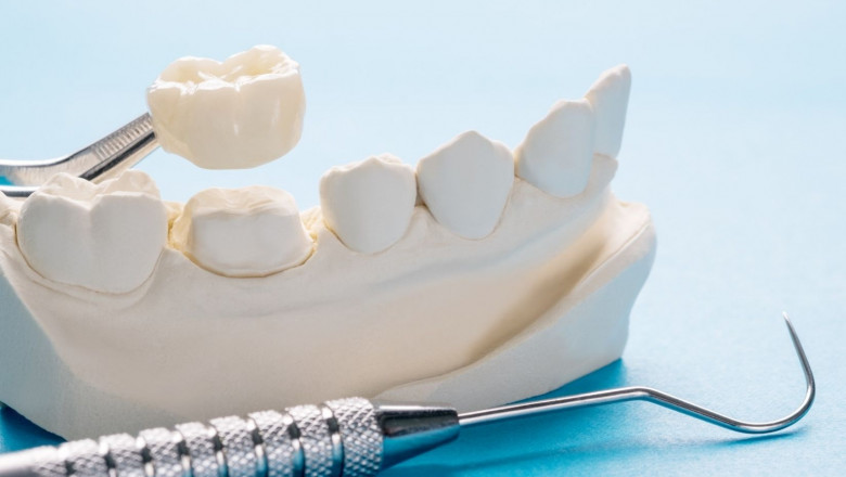 Dental Crowns Explained: Same-Day, Porcelain, Metal, and Implant-Supported