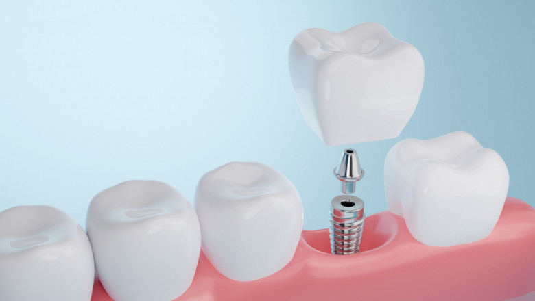 Dental Implant Louisville Ky - Restore Your Smile With Dental Implants