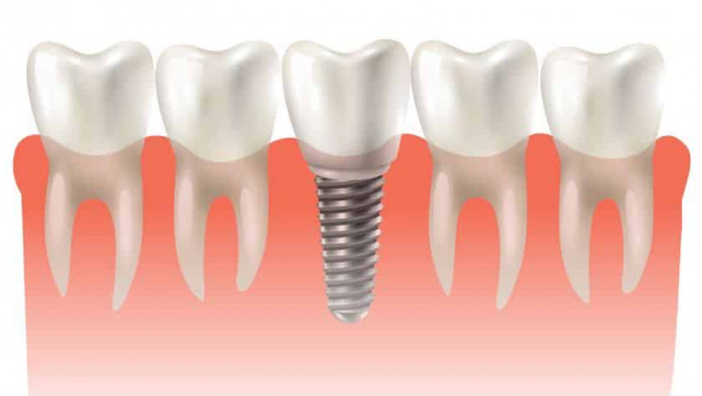 Dental Implants - A Natural-Looking and Functioning Solution