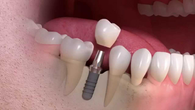 Dental Implants - A Single Tooth Implant Dallas TX