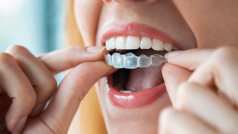Experience the Comfort of Clear Braces in Thibodaux LA