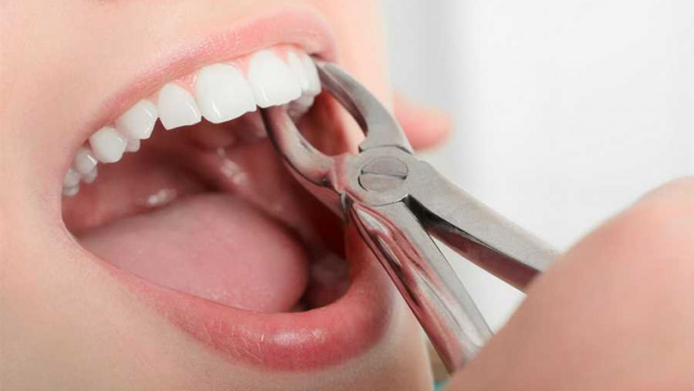 How to Prepare for Tooth Extraction