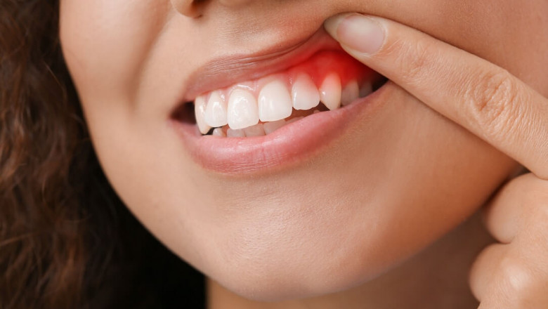 Periodontal Disease Treatment Options in Montgomery AL
