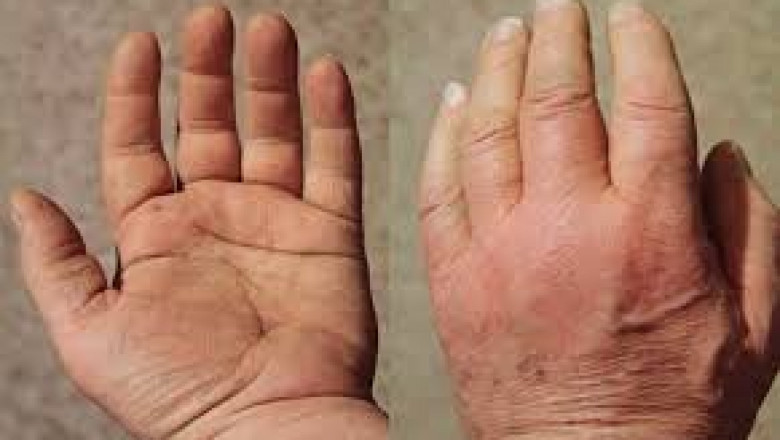 Polymyalgia Rheumatica Drugs Market Growth Forecast Overview