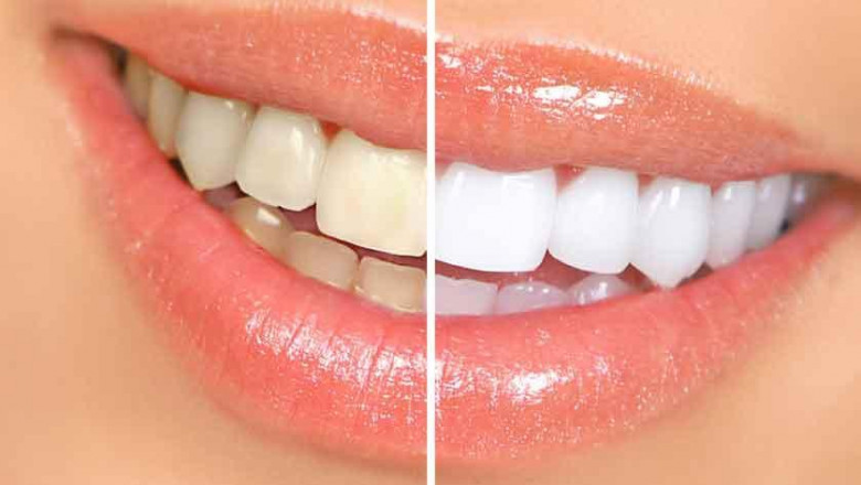 Teeth Whitening - Fast and Effective Way to Brighten Teeth and Boost Your Confidence