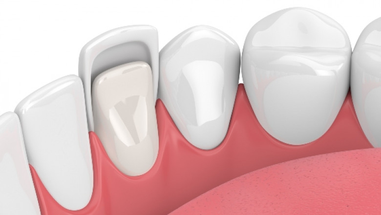 Tooth Replacement Options in Germany Town