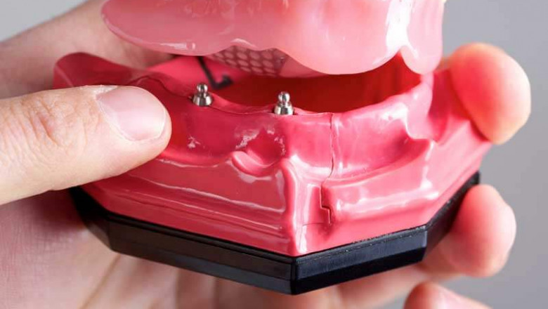 Transform Your Smile with Full Arch Dental Implants in Montgomery AL