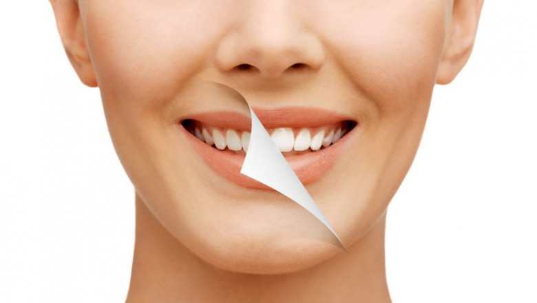Types of Cosmetic Dentistry: Transform Your Smile with Whitening, Veneers, Bonding, and Implants