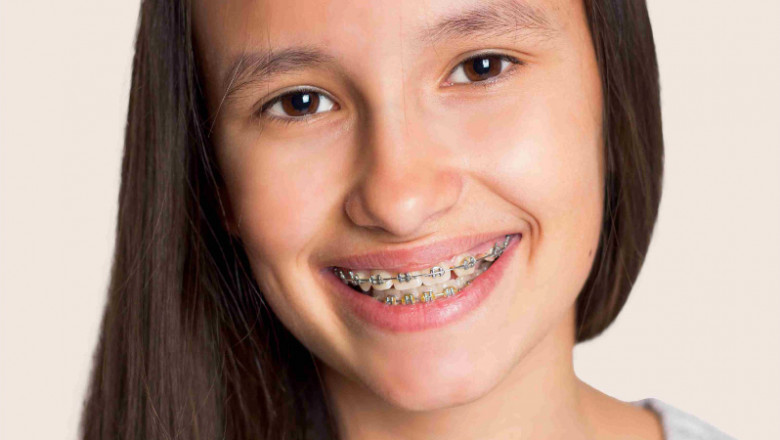 What Are the Costs of Orthodontic Treatment?