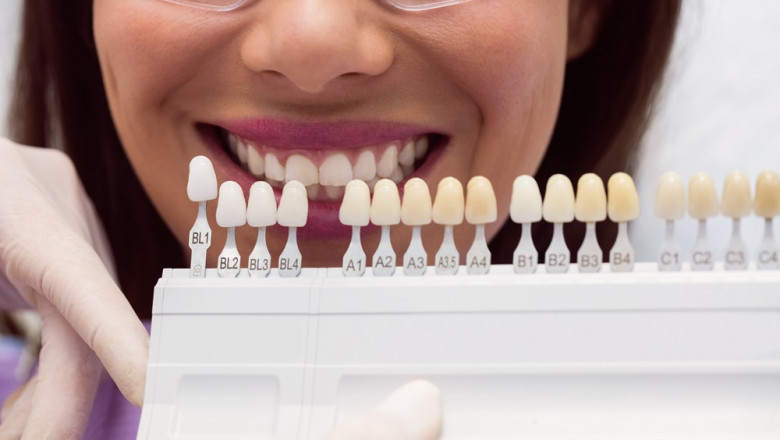 Transform Your Smile with Porcelain Veneers in SW Calgary at Heritage Park Dental