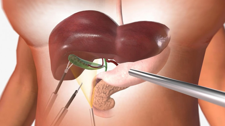 Understanding the Liver Transplant Procedure with Dr. Vivek Vij