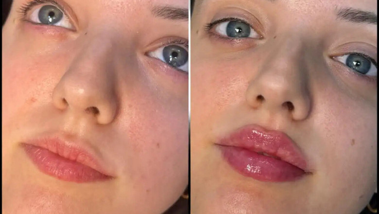Achieving Perfect Lip Volume with the Best Plastic Surgeon in Dubai for fillers