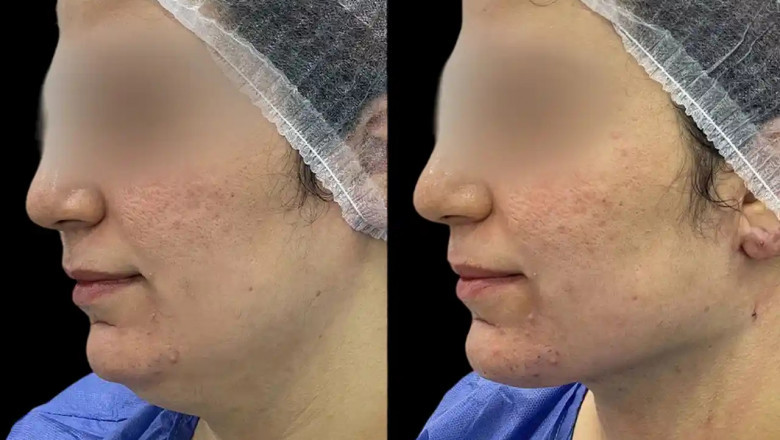 Best Plastic Surgeon in dubai for Chin Fillers: The Non-Invasive Alternative to Surgery