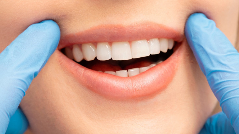 Tips to Maintain Your Professional Teeth Whitening Results