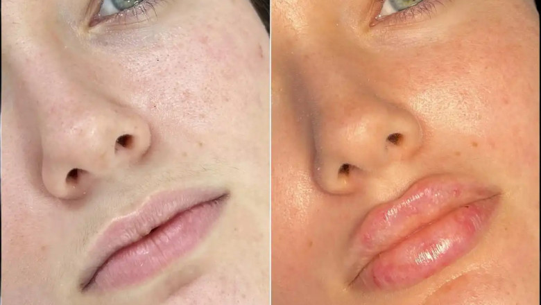 Find Confidence Through Fillers Treatment in Dubai