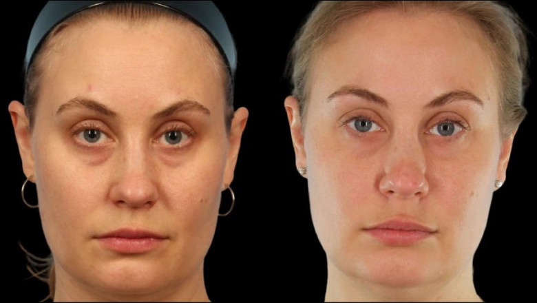 How Long Do Results Last for Under Eye Fillers Treatment in Dubai?